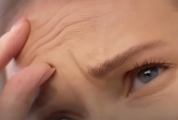 Контурная пластика лба